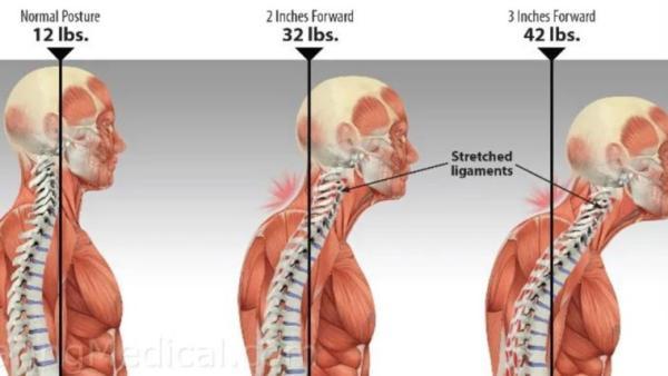 چطور ناهنجاری گردن پیامکی یا رو به جلو را اصلاح کنیم تا درد گردن و کمر بالایی خود را کاهش دهیم