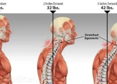 چطور ناهنجاری گردن پیامکی یا رو به جلو را اصلاح کنیم تا درد گردن و کمر بالایی خود را کاهش دهیم